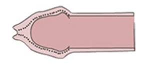 Fimosi: disegno esemplificativo Fimosi: disegno esemplificativo