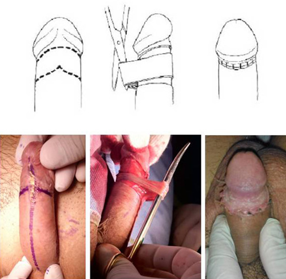 Fimosi: disegno esemplificativo